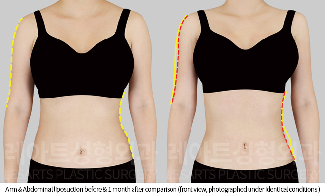 arm_liposuction_02_02_250808
