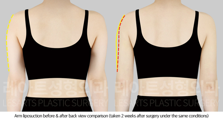 arm_liposuction_02_03_250722