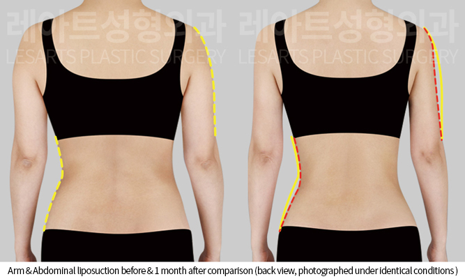 arm_liposuction_02_03_250808