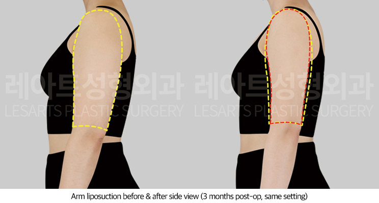 arm_liposuction_02_04_250711