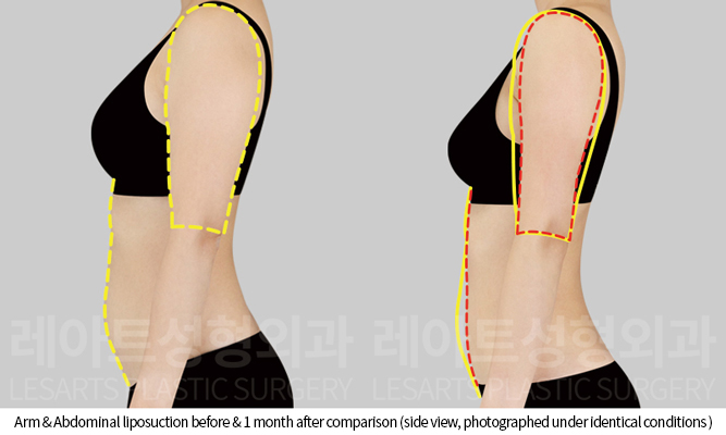 arm_liposuction_02_04_250808