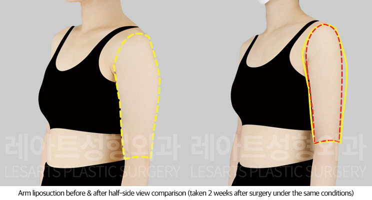 arm_liposuction_02_05_250722