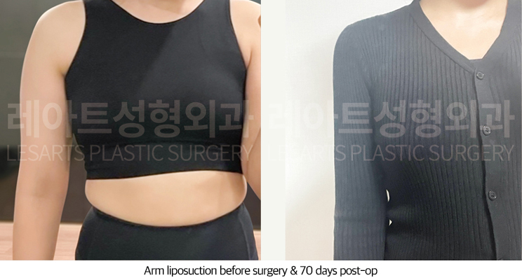 arm_liposuction_02_06_250711
