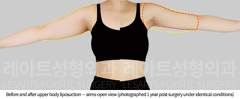 arm_liposuction_02_06_250812