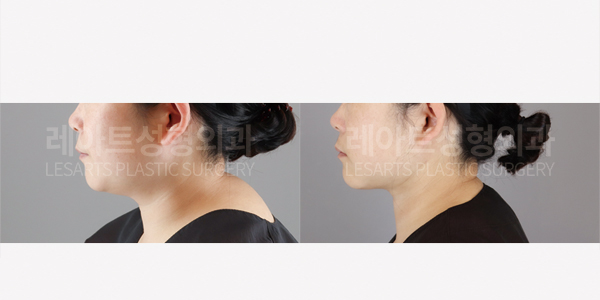 facial_liposuction_01_thumbnail_250710