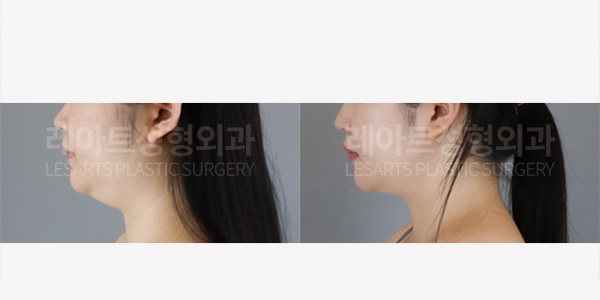 facial_liposuction_01_thumbnail_250717