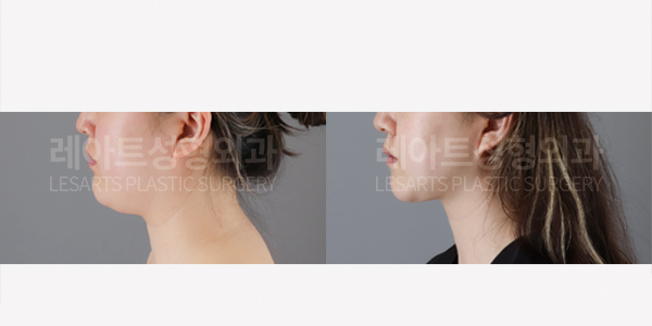 facial_liposuction_01_thumbnail_250724
