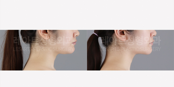 facial_liposuction_01_thumbnail_250731
