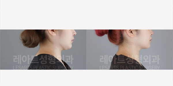 facial_liposuction_01_thumbnail_250807