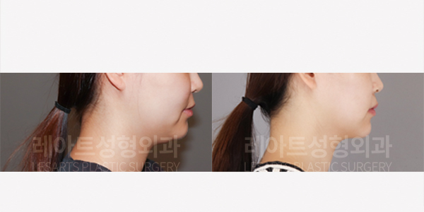 facial_liposuction_01_thumbnail_250814