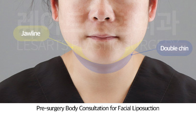 facial_liposuction_02_01_250710