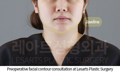 facial_liposuction_02_01_250807