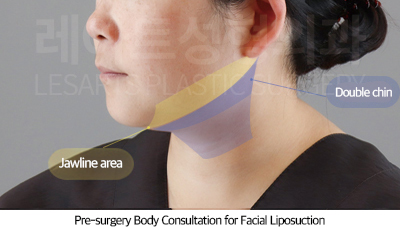 facial_liposuction_02_02_250710