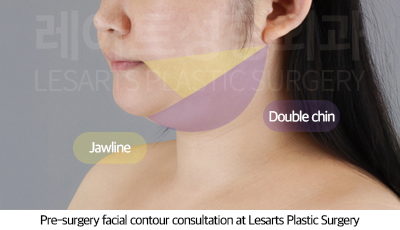 facial_liposuction_02_02_250717