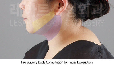 facial_liposuction_02_03_250710