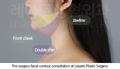 facial_liposuction_02_03_250717
