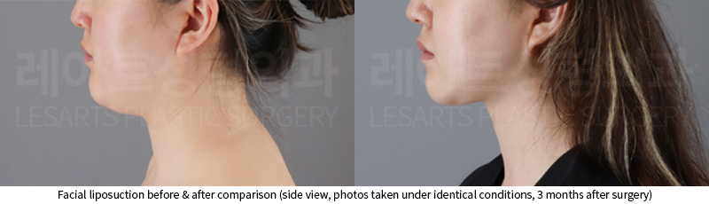 facial_liposuction_02_03_250724