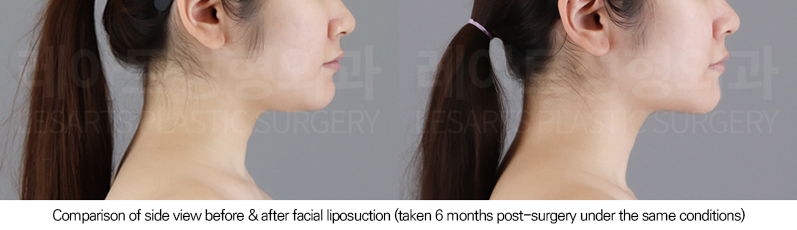facial_liposuction_02_04_250731