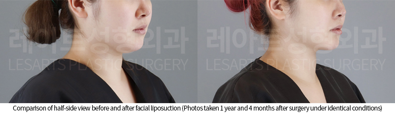 facial_liposuction_02_05_250807