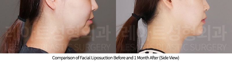 facial_liposuction_02_05_250814