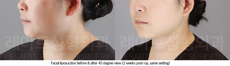 facial_liposuction_02_06_250710