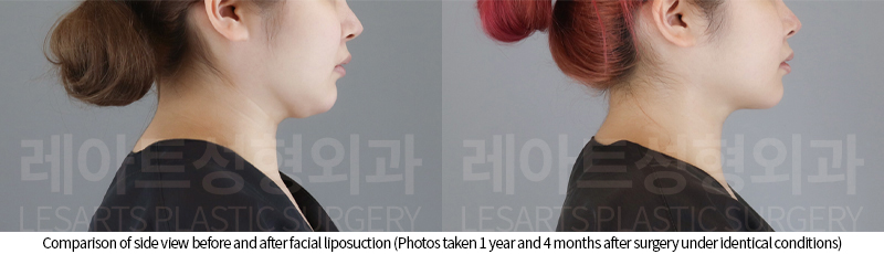 facial_liposuction_02_06_250807