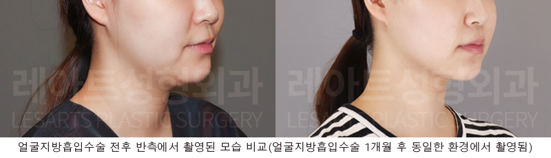 facial_liposuction_02_06_250814