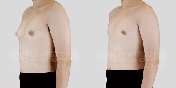 gynecomastia_01_thumbnail_250716