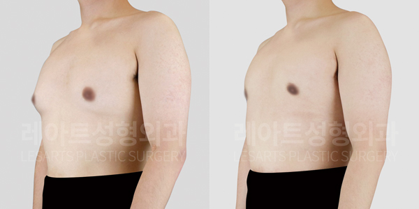 gynecomastia_01_thumbnail_250723