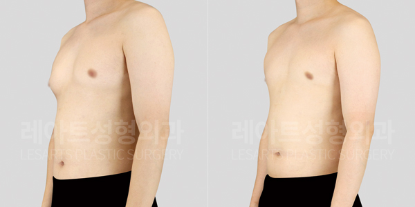 gynecomastia_01_thumbnail_250724