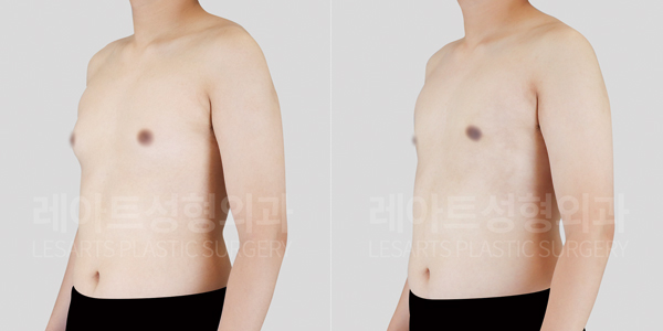 gynecomastia_01_thumbnail_250730