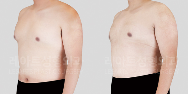 gynecomastia_01_thumbnail_250806
