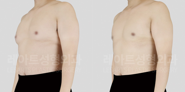 gynecomastia_01_thumbnail_250813