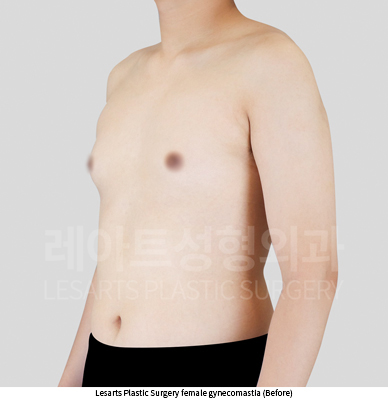gynecomastia_02_01_250730