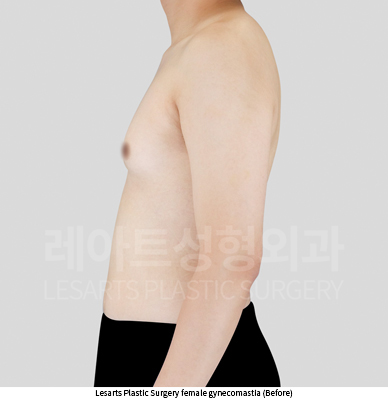 gynecomastia_02_02_250730