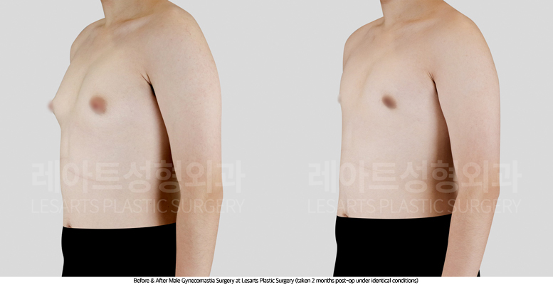 gynecomastia_02_03_250716