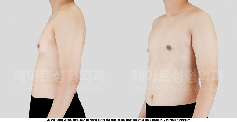 gynecomastia_02_03_250730
