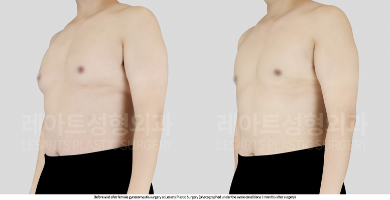gynecomastia_02_03_250813