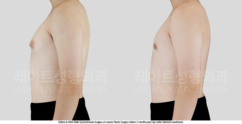 gynecomastia_02_04_250716