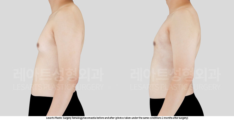 gynecomastia_02_04_250730