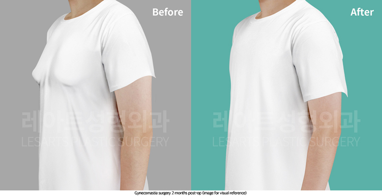 gynecomastia_02_05_250716
