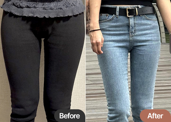 Gugugugde inner thigh liposuction before and after comparison – Best Liposuction Clinic in Korea Lesarts