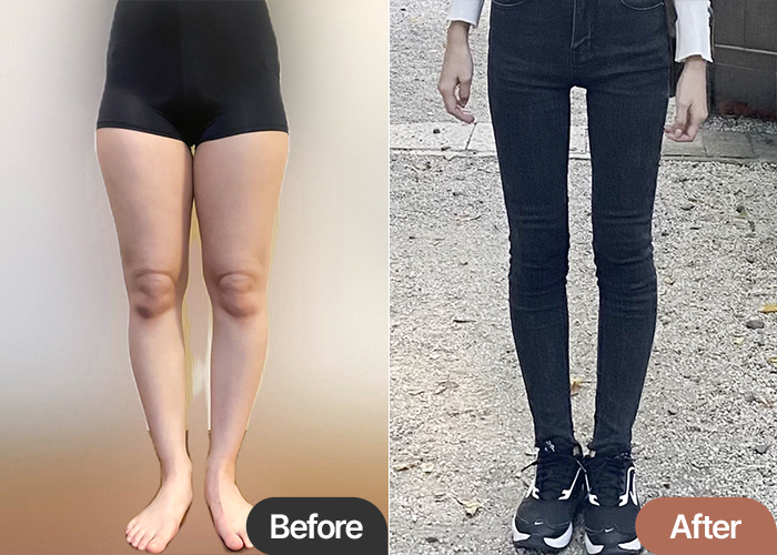 Uyupoku thigh liposuction before and after transformation – Best Liposuction Clinic in Korea Lesarts