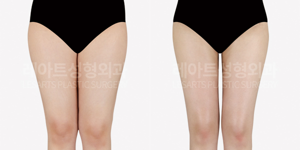 thigh_liposuction_01_thumbnail_250729