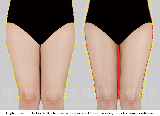 thigh_liposuction_02_02_250729