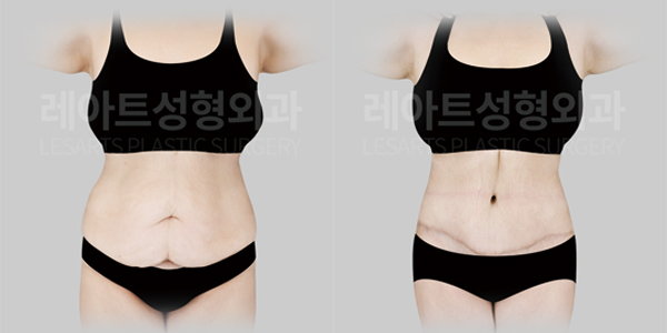 tummy_tuck_01_thumbnail_250714