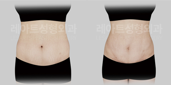 tummy_tuck_01_thumbnail_250804