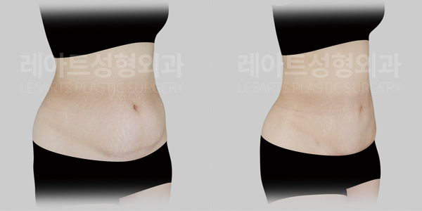 tummy_tuck_01_thumbnail_250811