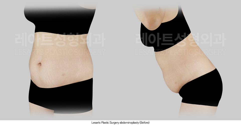tummy_tuck_02_02_250804