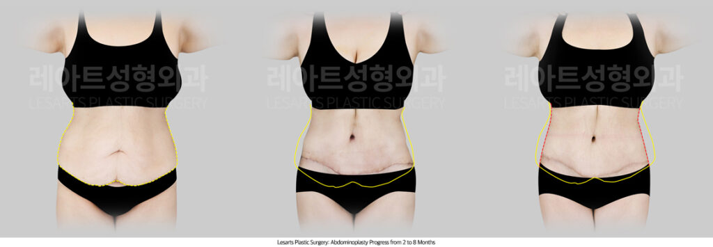 tummy_tuck_02_03_250714